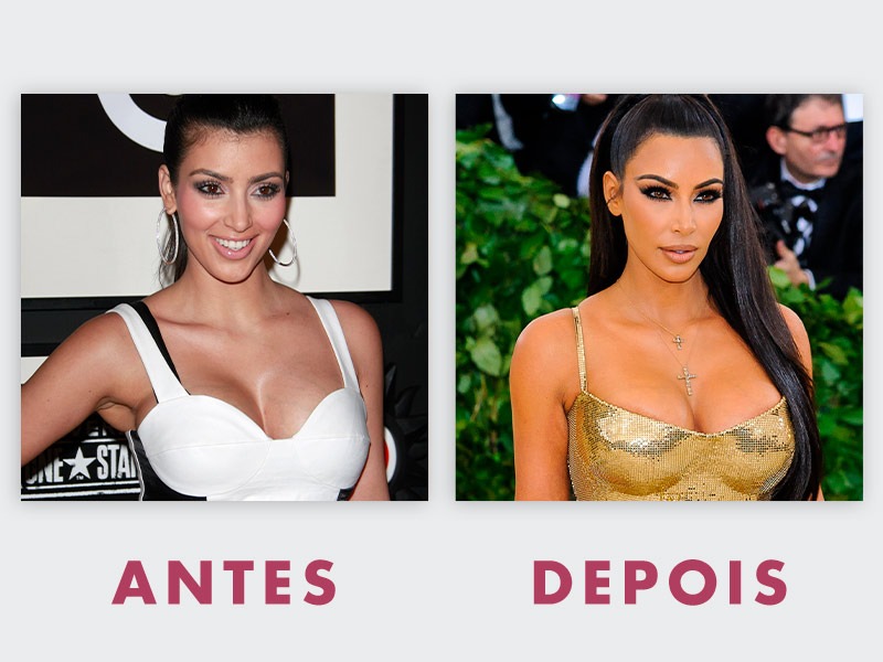 Kim Kardashian assume procedimentos estéticos