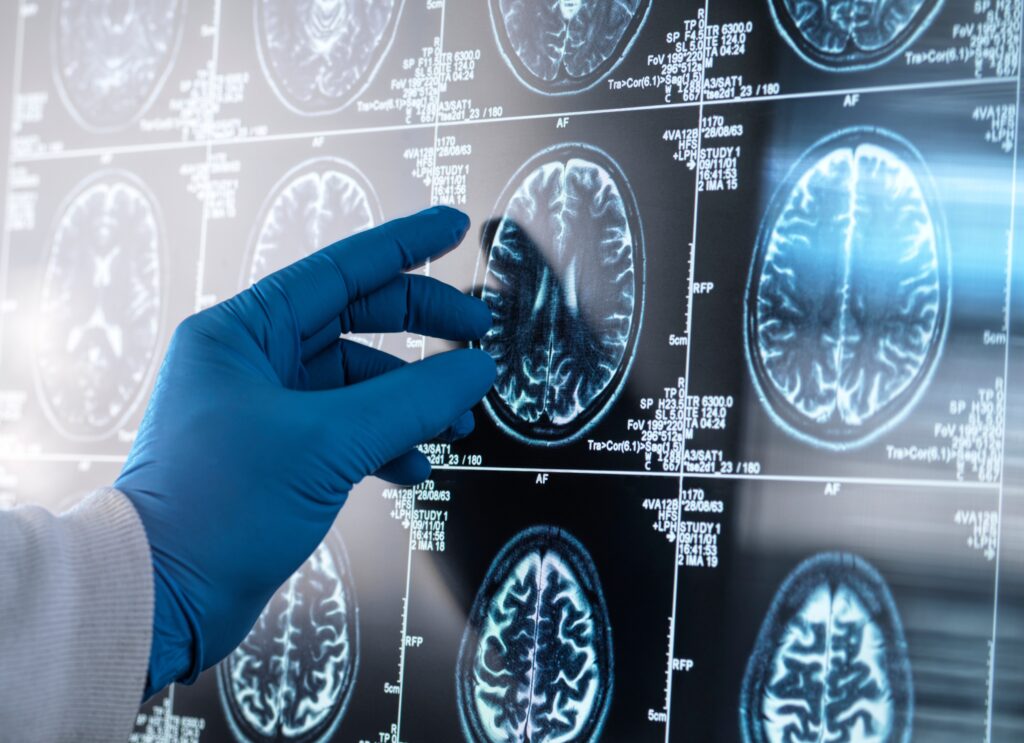 Inflamação no cérebro pode ser peça-chave na progressão do Alzheimer, revela estudo liderado por brasileiros