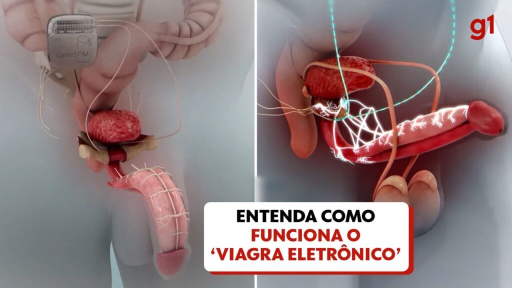 Viagra eletrônico: dispositivo criado por brasileiro recupera a ereção em 90% dos pacientes em estudo