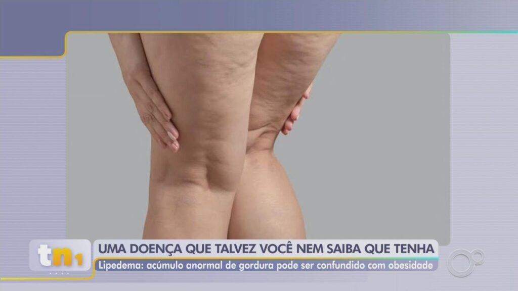 Novo estudo define critérios para diagnóstico por imagem do lipedema