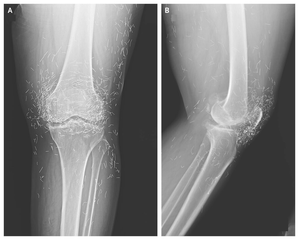 Fios de ouro em acupuntura aparecem no raio-X de paciente e médicos al