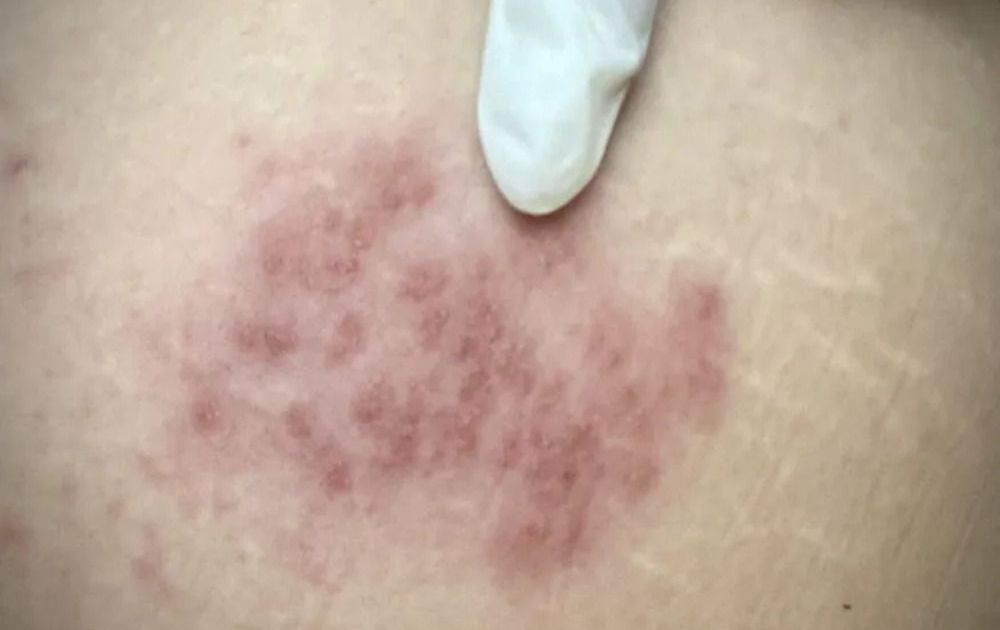 Risco de herpes-zóster aumenta depois dos 50 anos, diz médico a dr. Kalil