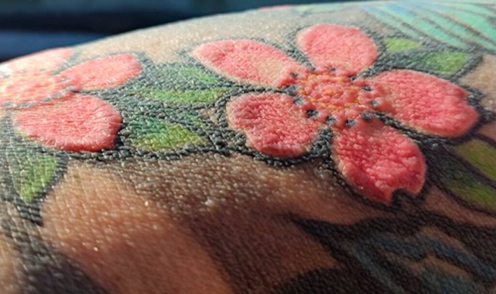 Reação rara a tatuagem faz homem perder cabelo e pelos, parar de suar e desenvolver vitiligo