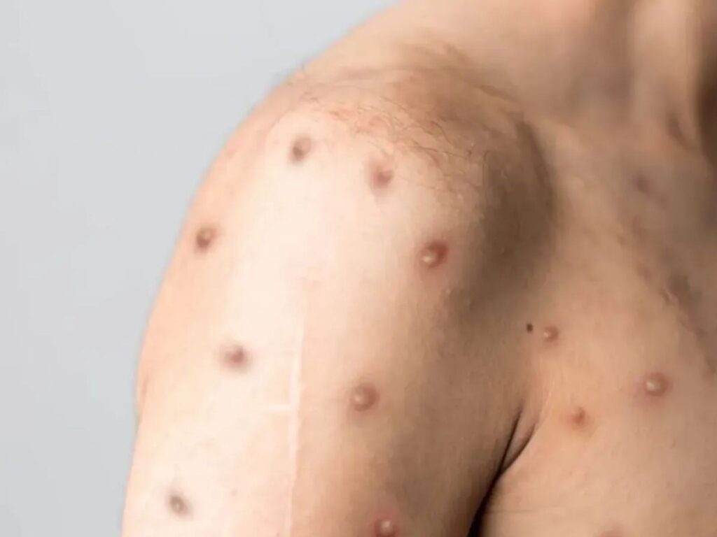 Casos de mpox sobem e Brasil chega a 88 registros; maioria está em SP